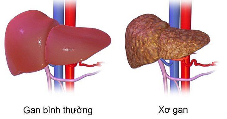 Gan bình thường và xơ gan